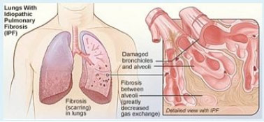 Lung-Fibrosis