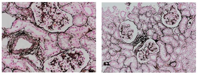 Jones Silver Stain demonstrates basement membrane and reticulin.