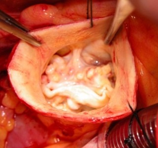 Surgeon's view of a bicuspid aortic valve.