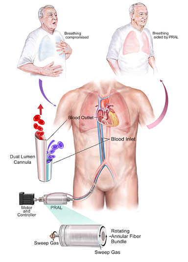 Flow image for Paracorporeal Respiratory Assist Lung